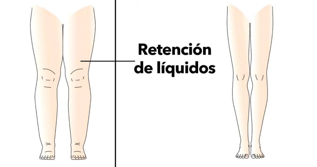 retención de líquidos